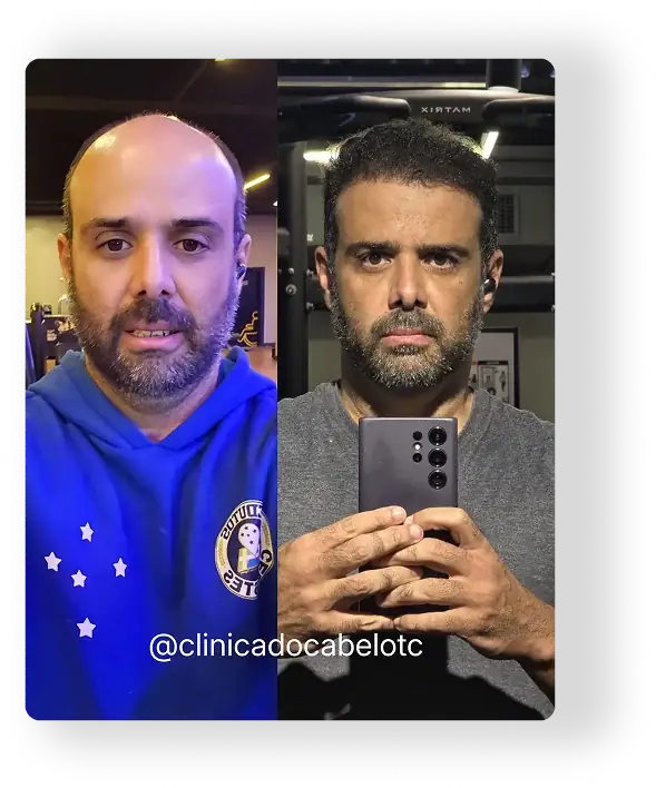 Antes e depois do transplante capilar - paciente 4
